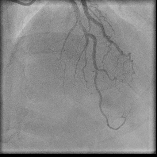 Normal coronary angiogram (DSA) (Radiopaedia 63081-71571 E 62).jpg