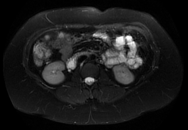 File:Normal liver MRI with Gadolinium (Radiopaedia 58913-66163 Axial T2 fat sat 15).jpg