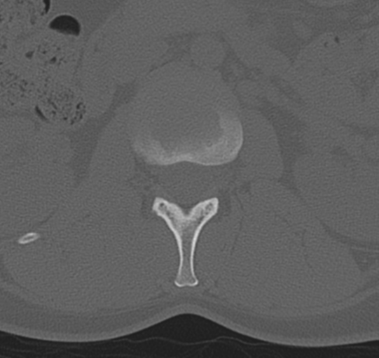 File:Normal lumbar spine CT (Radiopaedia 46533-50986 Axial bone window 16).png
