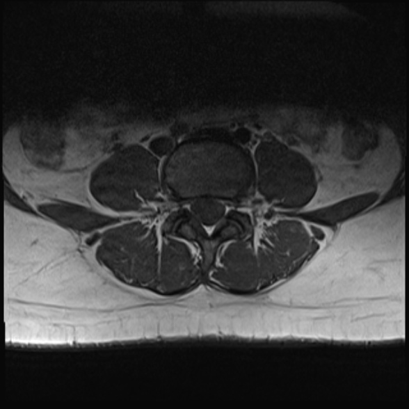 File:Normal lumbar spine MRI- 3 T (Radiopaedia 53280-59250 Axial 19).jpg