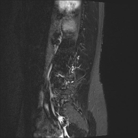 File:Normal lumbar spine MRI- 3 T (Radiopaedia 53280-59250 Sagittal STIR 21).jpg