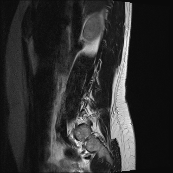 File:Normal lumbar spine MRI- 3 T (Radiopaedia 53280-59250 Sagittal T2 4).jpg