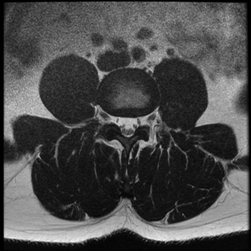 File:Normal lumbar spine MRI (Radiopaedia 35543-37039 Axial T2 21).png