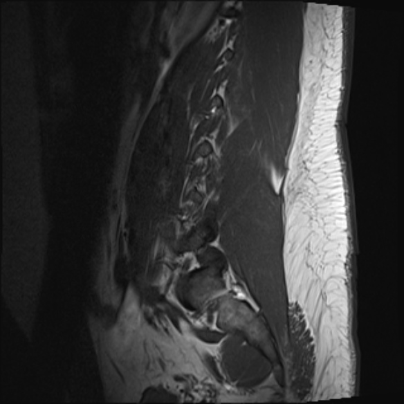 File:Normal lumbar spine MRI (Radiopaedia 47857-52609 Sagittal T1 2).jpg
