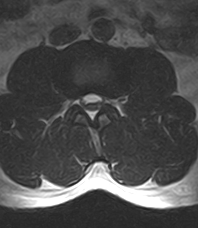 Normal lumbar spine MRI - low-field MRI scanner (Radiopaedia 40976-43699 Axial T2 48).jpg