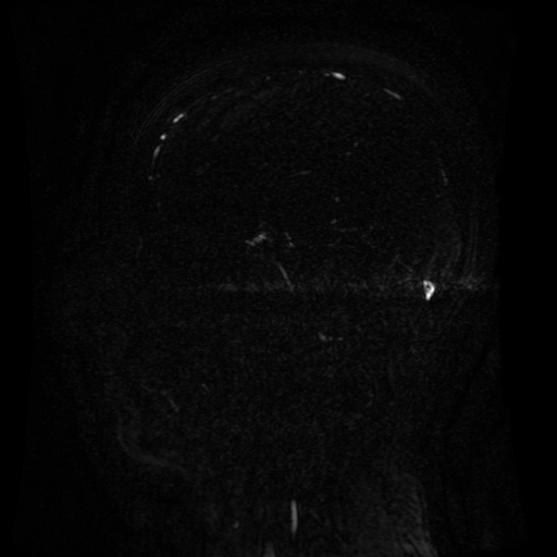 Normal noncontrast MR venography (Radiopaedia 87578-103957 A 74).jpg