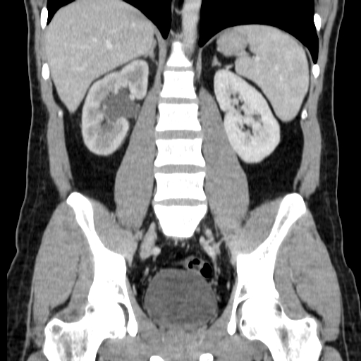 File:Obstructing ureteric calculus (Radiopaedia 18615-18514 C 49).jpg