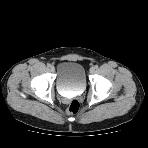 Obstructing ureteric calculus (Radiopaedia 18615-18514 D 53).jpg