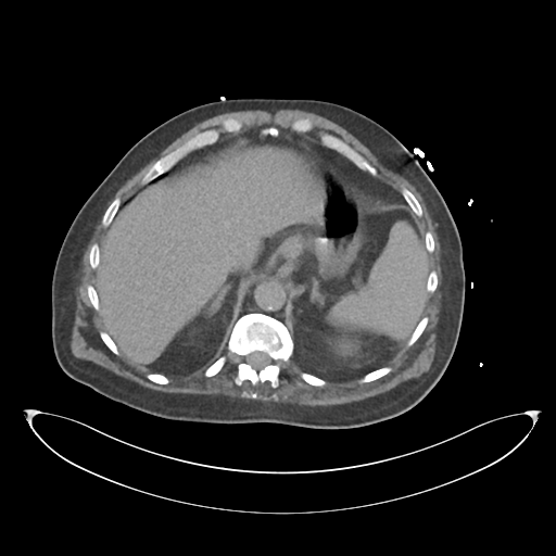 File:Obstructive pyelonephritis (Radiopaedia 46411-50844 Axial non-contrast 18).png