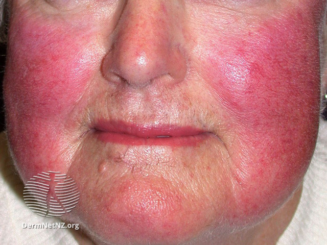 Rosacea (DermNet NZ acne-red-face-3618).jpg