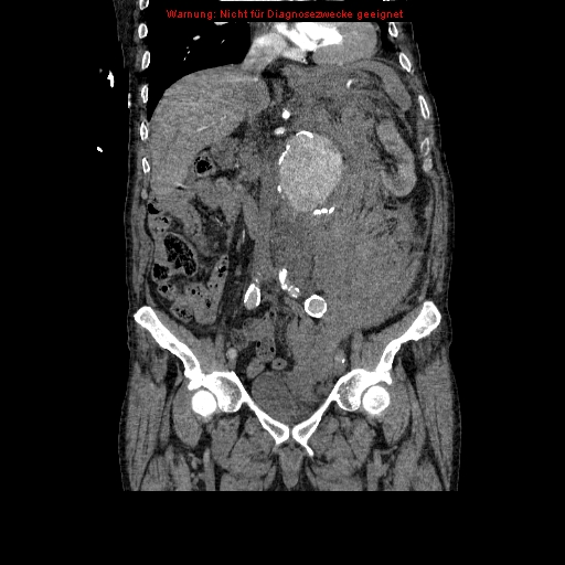 Abdominal aortic aneurysm- extremely large, ruptured (Radiopaedia 19882-19921 Coronal C+ arterial phase 50).jpg