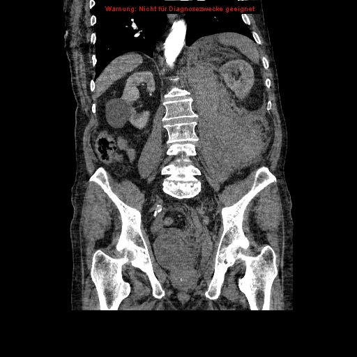 Abdominal aortic aneurysm- extremely large, ruptured (Radiopaedia 19882-19921 Coronal C+ arterial phase 68).jpg