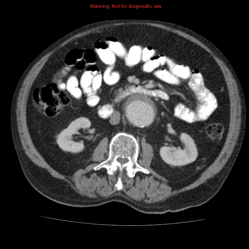 Abdominal aortic aneurysm (Radiopaedia 10122-10660 Axial C+ portal venous phase 35).jpg