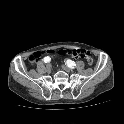 Abdominal aortic aneurysm (Radiopaedia 13341-13340 Axial C+ arterial phase 180).jpg