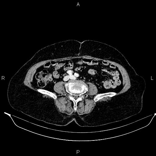 File:Abdominal aortic aneurysm (Radiopaedia 85063-100606 Axial C+ portal venous phase 48).jpg