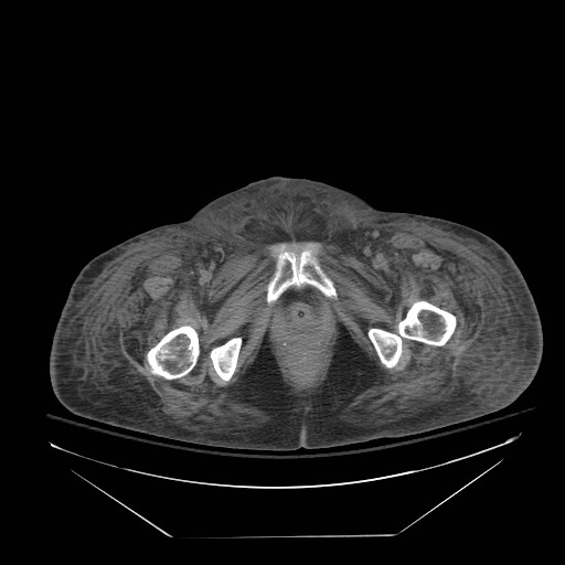 Abdominal aortic aneurysm - impending rupture (Radiopaedia 19233-19247 Axial non-contrast 170).jpg