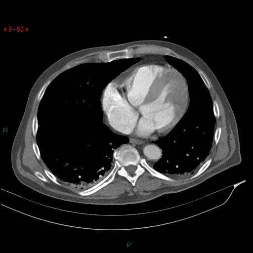 Abdominal aortic aneurysm rupture with aortocaval fistula (Radiopaedia 14897-14841 Axial C+ arterial phase 50).jpg