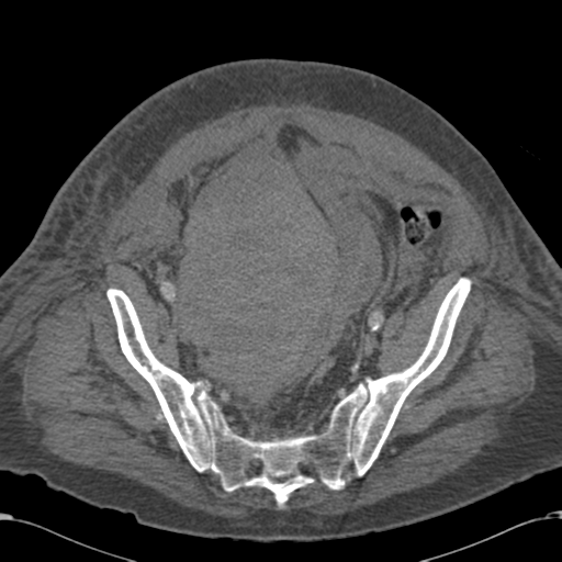 File:Abdominal hematoma (Radiopaedia 33614-34715 Axial C+ portal venous phase 105).png