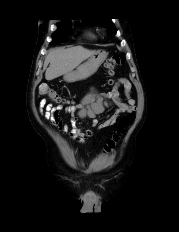 Abdominal lymphoma - with sandwich sign (Radiopaedia 53486-59492 C+ portal venous phase 47).jpg