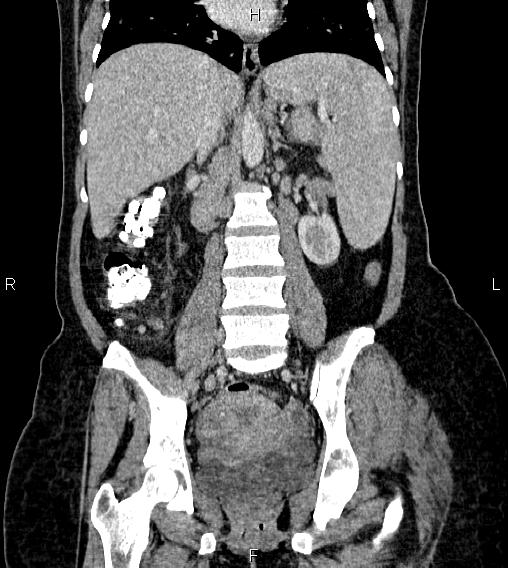Abdominal lymphoma with sandwich sign (Radiopaedia 84378-99704 Coronal C+ portal venous phase 39).jpg