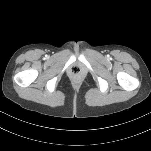 Abdominal multi-trauma - devascularised kidney and liver, spleen and pancreatic lacerations (Radiopaedia 34984-36486 Axial C+ portal venous phase 87).png
