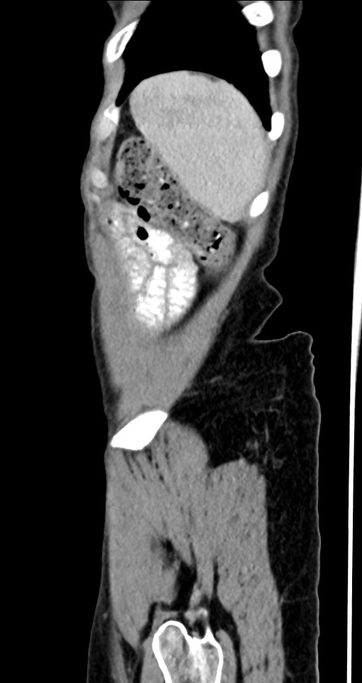 Abdominal wall and retroperitoneal tuberculosis (Radiopaedia 88137-104729 Sagittal C+ portal venous phase 21).jpg