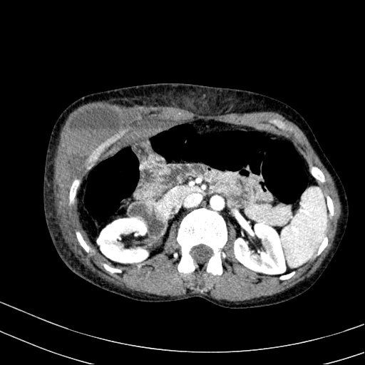 Abdominal wall hematoma with active bleeding (Radiopaedia 83915-99117 Axial renal cortical phase 22).jpg