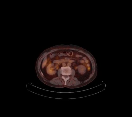 Abdominal wall metastasis from colorectal carcinoma (Radiopaedia 31016-31719 C 66).jpg