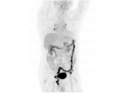 File:Abdominal wall metastasis from colorectal carcinoma (Radiopaedia 31016-31719 Rotational MIP 29).jpg