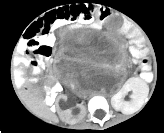 Abdominopelvic rhabdomyosarcoma (Radiopaedia 78356-90984 Axial C+ portal venous phase 84).jpg