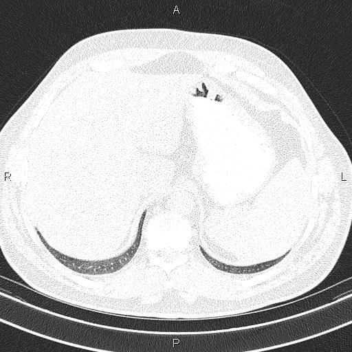 Aberrant right subclavian artery (Radiopaedia 87093-103354 Axial lung window 102).jpg