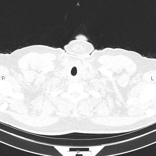 Aberrant right subclavian artery (Radiopaedia 87093-103354 Axial lung window 2).jpg