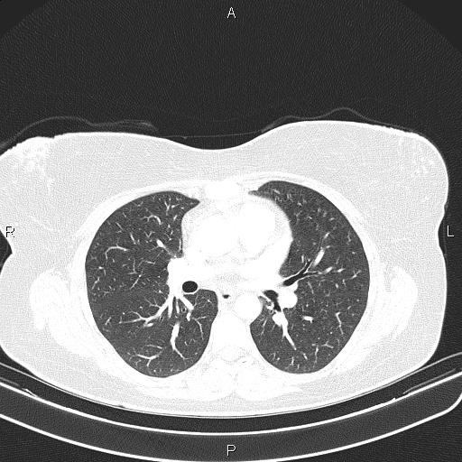 File:Aberrant right subclavian artery (Radiopaedia 87334-103629 Axial lung window 33).jpg