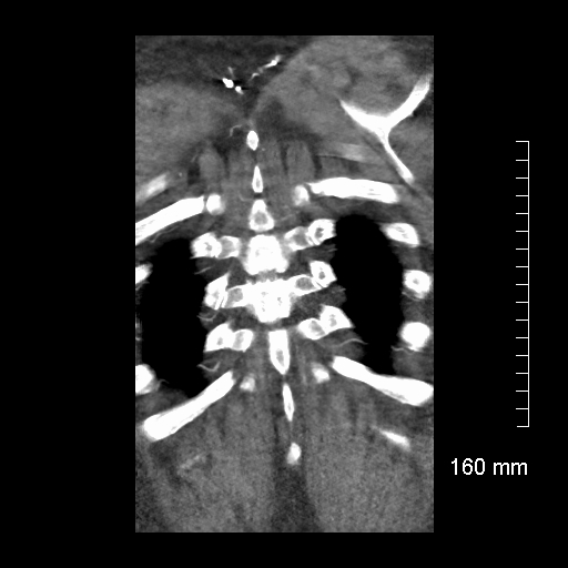 Aberrant right subclavian artery stenosis (Radiopaedia 52656-58670 B 76).jpg