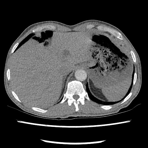 Accessory left horizontal fissure with lingular pneumonia (Radiopaedia 53763-59843 Axial C+ CTPA 82).jpg