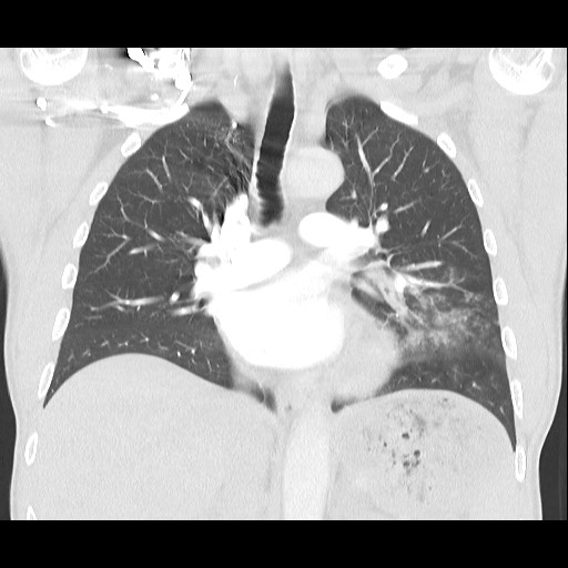 Accessory left horizontal fissure with lingular pneumonia (Radiopaedia 53763-59843 Coronal lung window 24).jpg