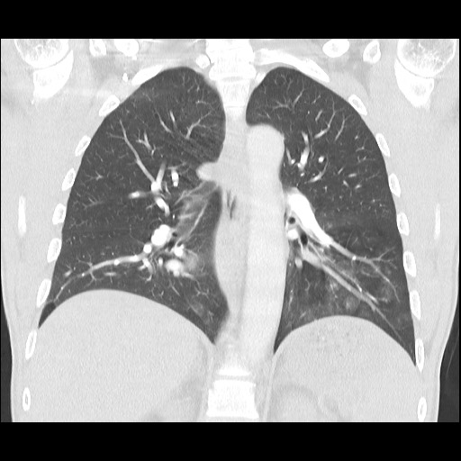 Accessory left horizontal fissure with lingular pneumonia (Radiopaedia 53763-59843 Coronal lung window 28).jpg