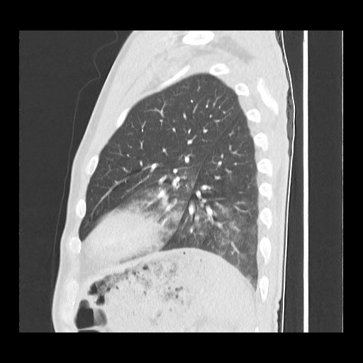 Accessory left horizontal fissure with lingular pneumonia (Radiopaedia 53763-59843 Sagittal lung window 52).jpg