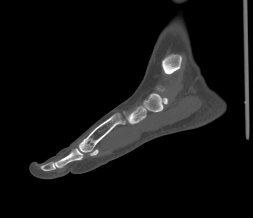 File:Accessory navicular bone (Radiopaedia 54999-61314 Sagittal non-contrast 31).jpg