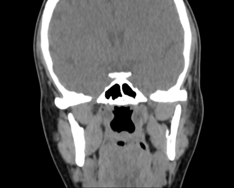Accessory parotid gland (Radiopaedia 76207-87772 Coronal non-contrast 66).jpg