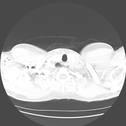 Achalasia (Radiopaedia 52507-58417 Axial lung window 3).jpg