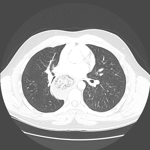 File:Achalasia (Radiopaedia 52507-58417 Axial lung window 32).jpg