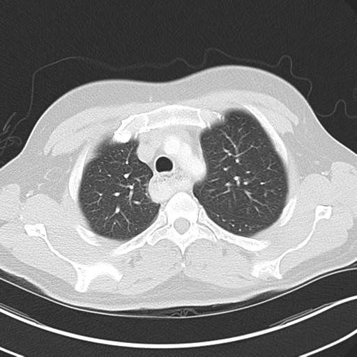 Achalasia of the cardia (Radiopaedia 38497-40595 Axial lung window 14).png