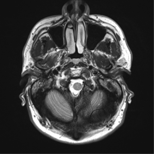 File:Achondroplasia (Radiopaedia 65109-74105 Axial T2 2).png