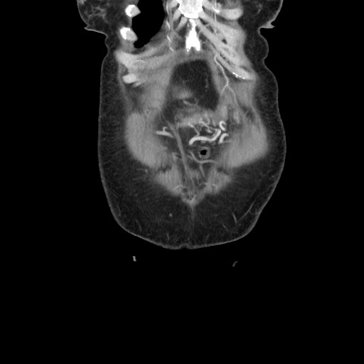 File:Acinar cell carcinoma of the pancreas (Radiopaedia 75442-86669 Coronal C+ portal venous phase 16).jpg