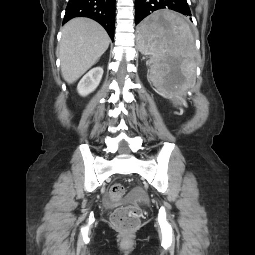 File:Acinar cell carcinoma of the pancreas (Radiopaedia 75442-86669 Coronal C+ portal venous phase 94).jpg
