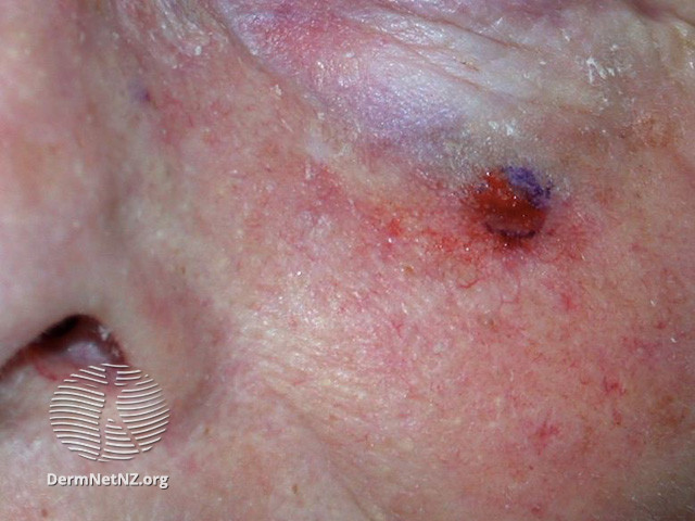 Actinic Keratoses affecting the face (DermNet NZ lesions-ak-face-388).jpg