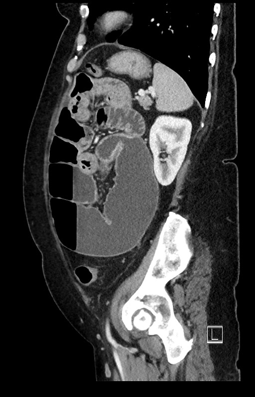 Active Crohn disease (Radiopaedia 59394-66750 Sagittal C+ portal venous phase 16).jpg