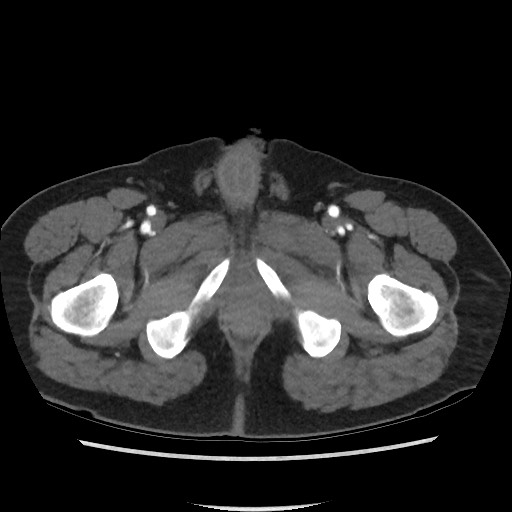 File:Active colonic bleed on CT (Radiopaedia 49765-55025 Axial C+ arterial phase 88).jpg