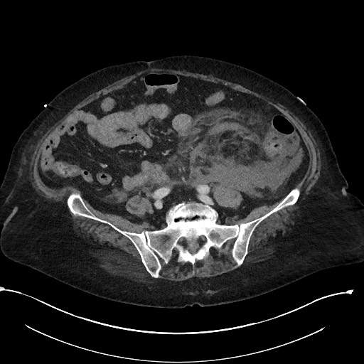 File:Active renal extravasation with large subcapsular and retroperitoneal hemorrhage (Radiopaedia 60975-68796 Axial 248).jpg